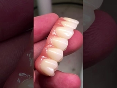 Porcelain Veneer Oral Restoration