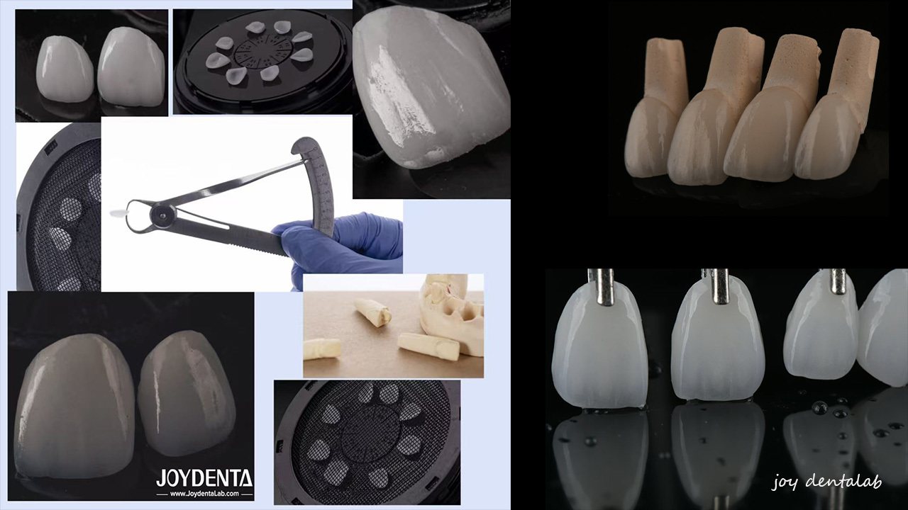 Latest company blogs about Emax Dental Veneers | Global Premium Manufacturer