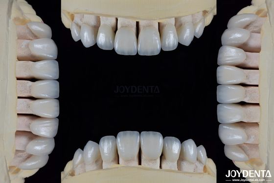Ceramic For Natural Aesthetics Dental Veneers Stain Resistance Maintains Brightness Strong Bond With Tooth Enamel For Secure Fit