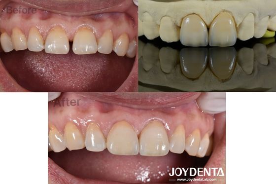 0.5mm Thickness Dental Veneers Perfect Permeability Porcelain Veneers For Gap Teeth