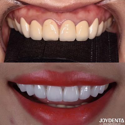 CAD/CAM Compatible Zirconia Dental Crowns Precision Manufacturing For Tailored Shades And Sizes