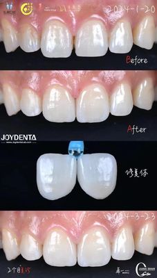 Anterior Tooth Indication Dental Veneers With No Preparation Needed And No Discoloration