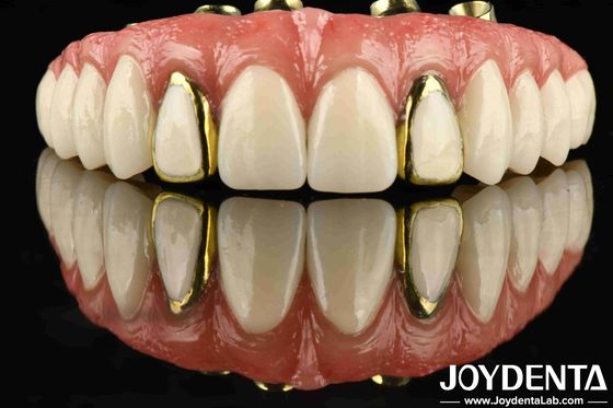 Experience The Durability Of Titanium Malong Hybrid Bridge For Applicable Dentistry
