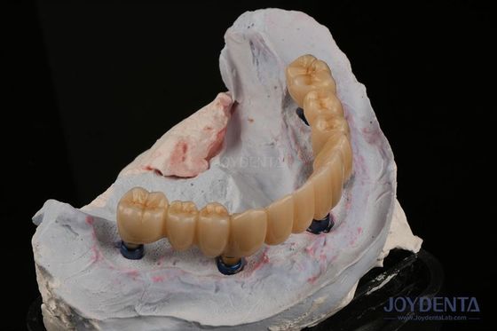 Buy Dental Restorations Multiple Teeth Implant Endosseous Replace Two Front Teeth online manufacture