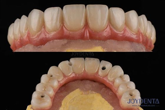 Buy Rough Surface Dental Teeth Implant Platform Dental Bridges With Internal Connection online manufacture