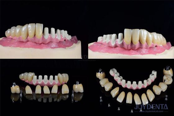 Buy Multiple Endosseous Dental Implants Internal Connection For Full Arch Restoration online manufacture