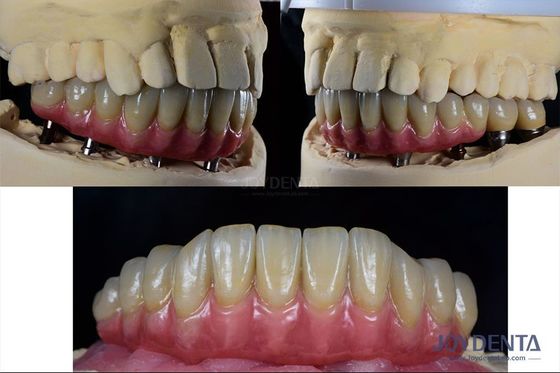 Buy Dental Reconstruction Multiple Teeth Implant Titanium Prosthetic Connection Internal online manufacture