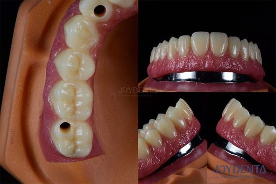 Buy Titanium Multiple Dental Implants Teeth Internal Implants Cracking Resistant Customized online manufacture