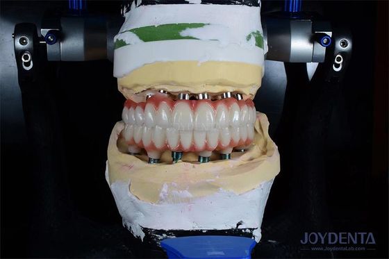 Buy 10mm Length Single Tooth Implant Gamma Irradiated For Optimal Surgical Outcomes online manufacture