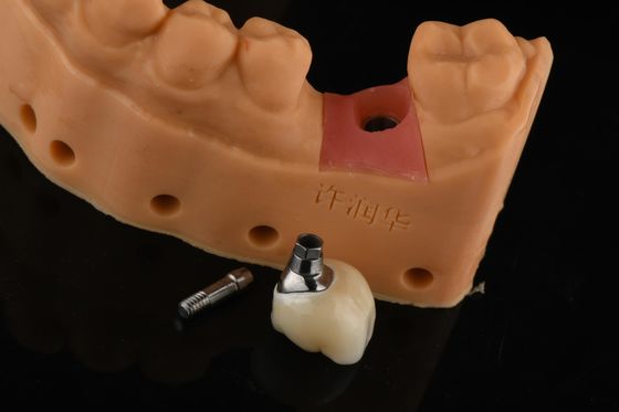 Buy Precision Cylindrical Silver Single Tooth Replacement Implants Dental Restoration online manufacture