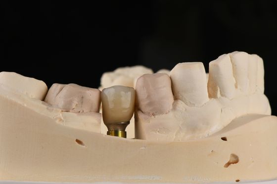 Buy Sandblasted Single Tooth Implant With Self Tapping Thread And Internal Hex Connection online manufacture