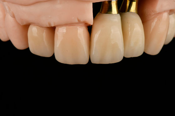 Buy Titanium Sandblasted Single Tooth Replacement Implant With Gamma Irradiation Sterilization online manufacture