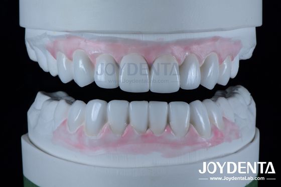 Buy Highly Accurate Dental Restorations Wax Up In Dentistry 1-2mm Thickness online manufacture