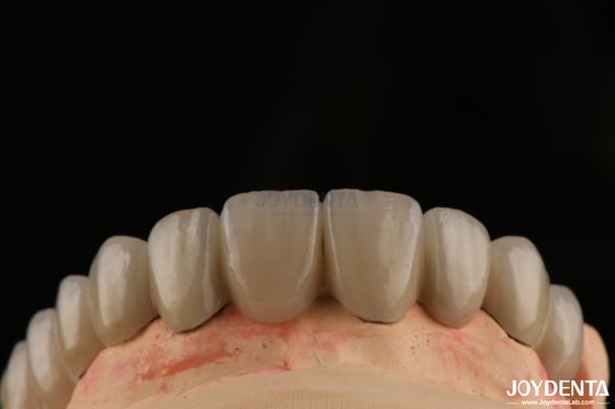 Buy PFM Porcelain Fused to Metal Crowns and Bridges Seamless Bonding for Natural Smiles online manufacture
