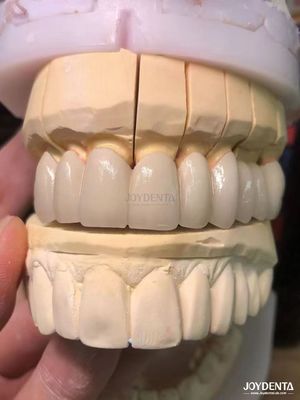 Buy Precision Fit Porcelain Fused to Metal PFM Crowns Seamless Natural Smile Enhancement online manufacture