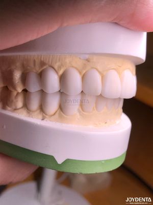 Buy Customized Digital Diagnostic Wax Ups for Natural Tooth Anatomy Replication online manufacture