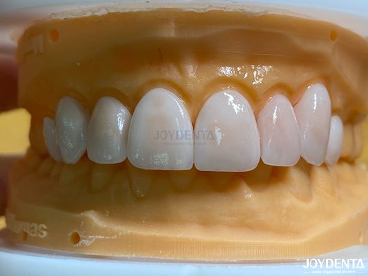 Buy Lightweight and Smooth Dental Veneers Stain Resistance Long-lasting Durability for Optimal Comfort online manufacture