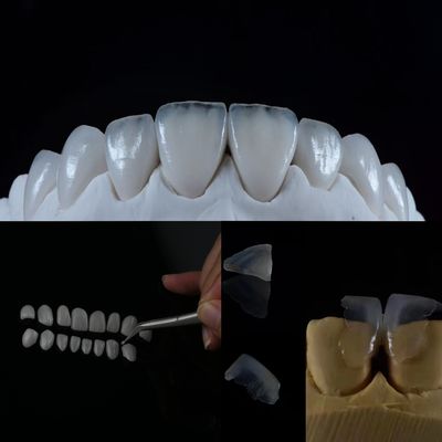 Buy Glass Ceramic Veneer Achieve a Natural-Looking Smile with This Superior Dental Solution online manufacture