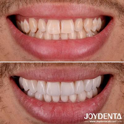 Buy Perfect Fit Porcelain Teeth Veneers	Natural Transparency Dental Laminate Veneers online manufacture