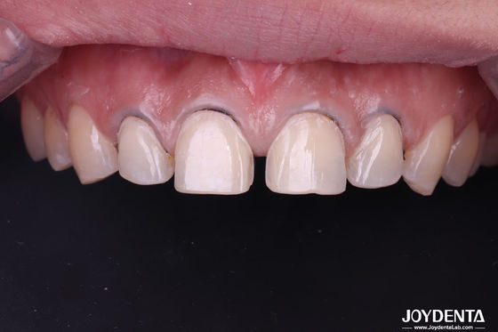 Buy Real Looking Dental Porcelain Veneers Perfectly Fit Ceramic Teeth Veneers For Front Teeth online manufacture