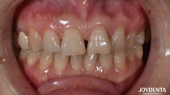 Buy 0.5mm Thickness Ceramic Dental Veneers Natural Looking For Anterior Tooth Indication online manufacture