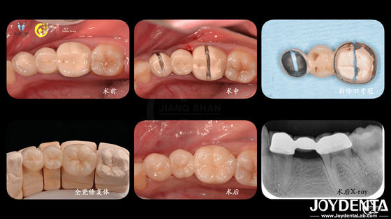 Buy Tailored Dental Zirconia Crown Biocompatibility Comfort Customization For Optimal Patient Experience online manufacture
