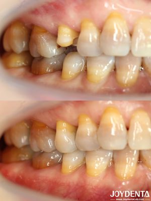 Buy Customizable Affordable Dental Inlay Restorative Precise Fit For Damaged Teeth online manufacture