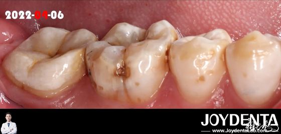 Buy Natural Color Accurate Fit Dental Inlay For Damaged Teeth Restoration online manufacture