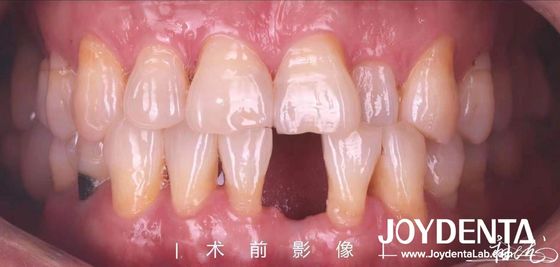 Buy Customizable Dental Maryland Resin Bonded Bridges for Anterior And Premolar Teeth online manufacture