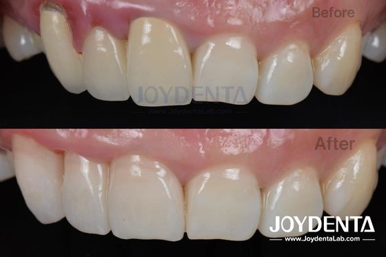 Buy Painless Procedure BOPT Dental Technique for Accurate Tooth Preparation online manufacture