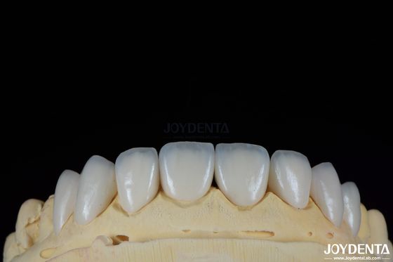 Buy Glossy Surface Texture Feldspathic Veneer Natural Looking Porcelain Veneer online manufacture
