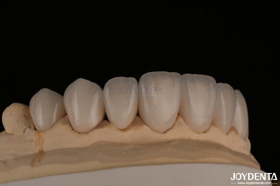 Buy Feldspathic Natural Looking Cosmetic Veneers Precise Fit Highly Translucent online manufacture