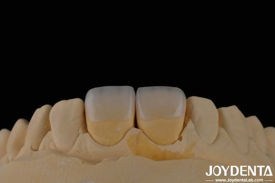 Buy Long Lasting Dental Feldspathic Veneer Natural Tooth Color Translucent Appearance online manufacture