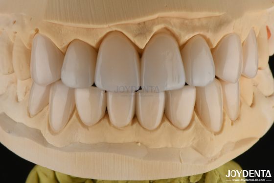 Buy 0.3-0.5mm Thick Feldspathic Porcelain Veneer High Fracture Resistance Upgrade Your Smile online manufacture