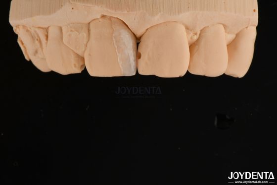 Buy Thin Shell Micro Veneer Cosmetic Dental Treatment Micro Thin Teeth Veneers online manufacture