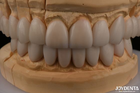 Buy 0.3mm Thickness Ips Emax Veneers Ceramic Veneers Anterior Posterior Restorations online manufacture
