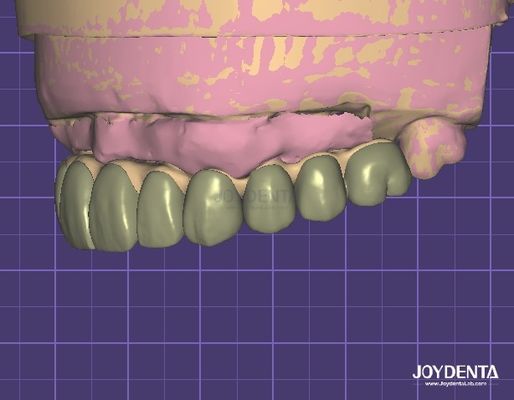 Buy HIPAA Compliant Data Security Digital Wax Up 3D Model For Dental Modifications online manufacture
