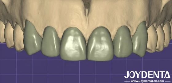 Buy 3D Printing Virtual Digital Wax Up Seamless Compatibility With Other Dental Software online manufacture