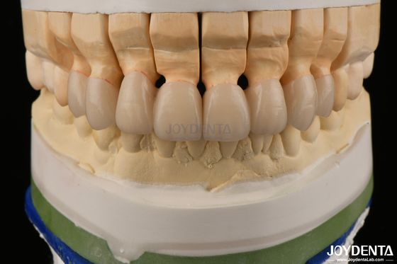 Buy High Translucency Layered Zirconia Crowns Bridges Dental Restorations lifelike appearance online manufacture