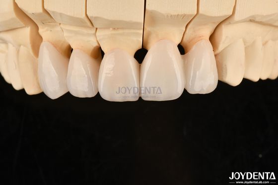 Buy Highly Customizable Layered Zirconia Dental Crowns And Bridges Long Lasting Solution online manufacture