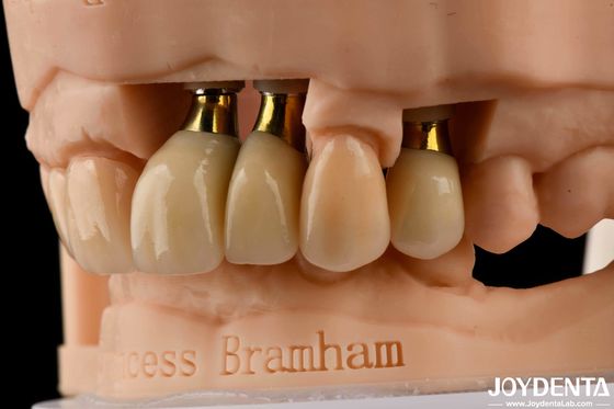Buy Precision Dental Implant Crown and Bridge Perfect Solution for Aesthetically Pleasing Smile online manufacture