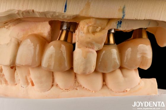 Buy Restoration Of Missing Teeth Implant Crown and Bridge Safe For Oral with Accurate Fit online manufacture