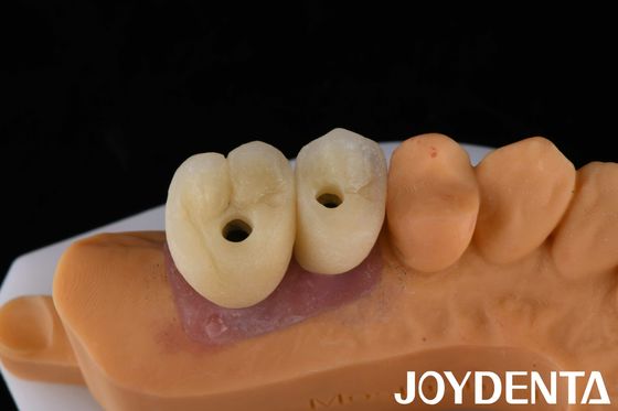 Buy Porcelain Implant Crown and Bridge The Ultimate Solution for Restoration Of Missing Teeth online manufacture