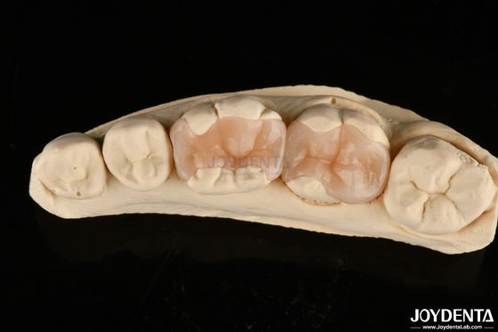Buy Natural Polymerized Porcelain Dental Inlay Onlay For Tooth Restoration online manufacture