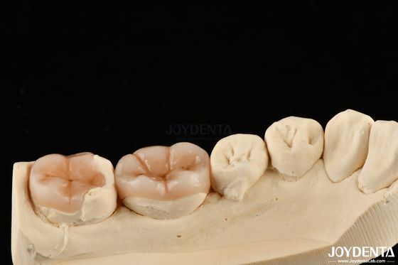 Buy Natural Looking Composite Inlay Onlay Dental Restoration With Natural Appearance online manufacture