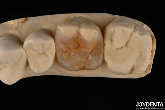 Buy Custom Compound Inlay Onlay For Minimally Invasive Dental Restoration online manufacture
