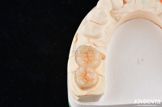 Buy Natural Looking Dental Zirconia Inlays And Onlays High Esthetically Precise Fit online manufacture