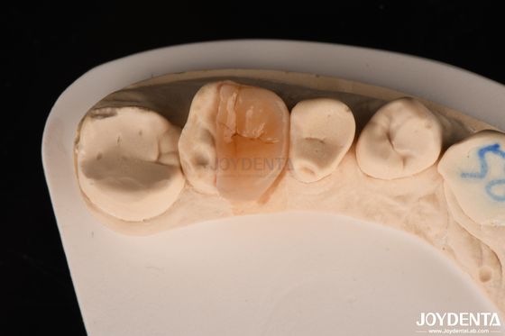 Buy Zirconia Inlay Onlay With Adhesive Cementation For Damaged Teeth Restoration online manufacture