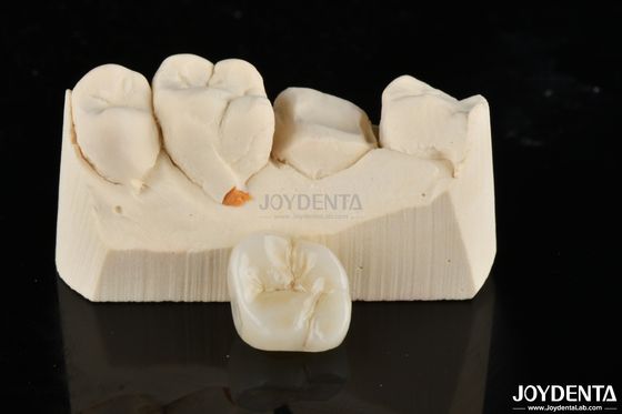 Buy Zirconia Inlays And Onlays Tailor Made Restorations For Unparalleled Fit And Esthetics online manufacture
