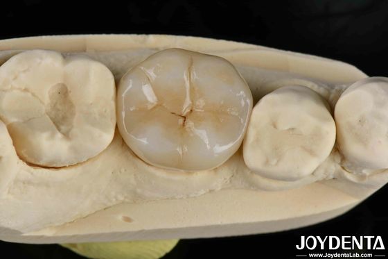 Buy Adhesive Cementation Zirconia Dental Inlays And Onlays Natural Looking online manufacture